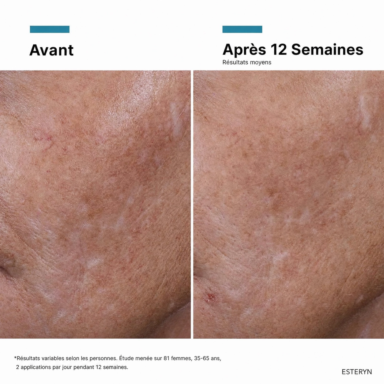 Esteryn™ Volume Recall Serum